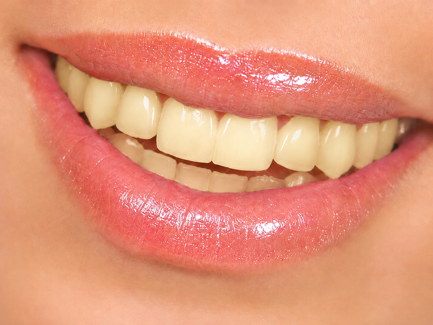 Clareamento Dental — antes
