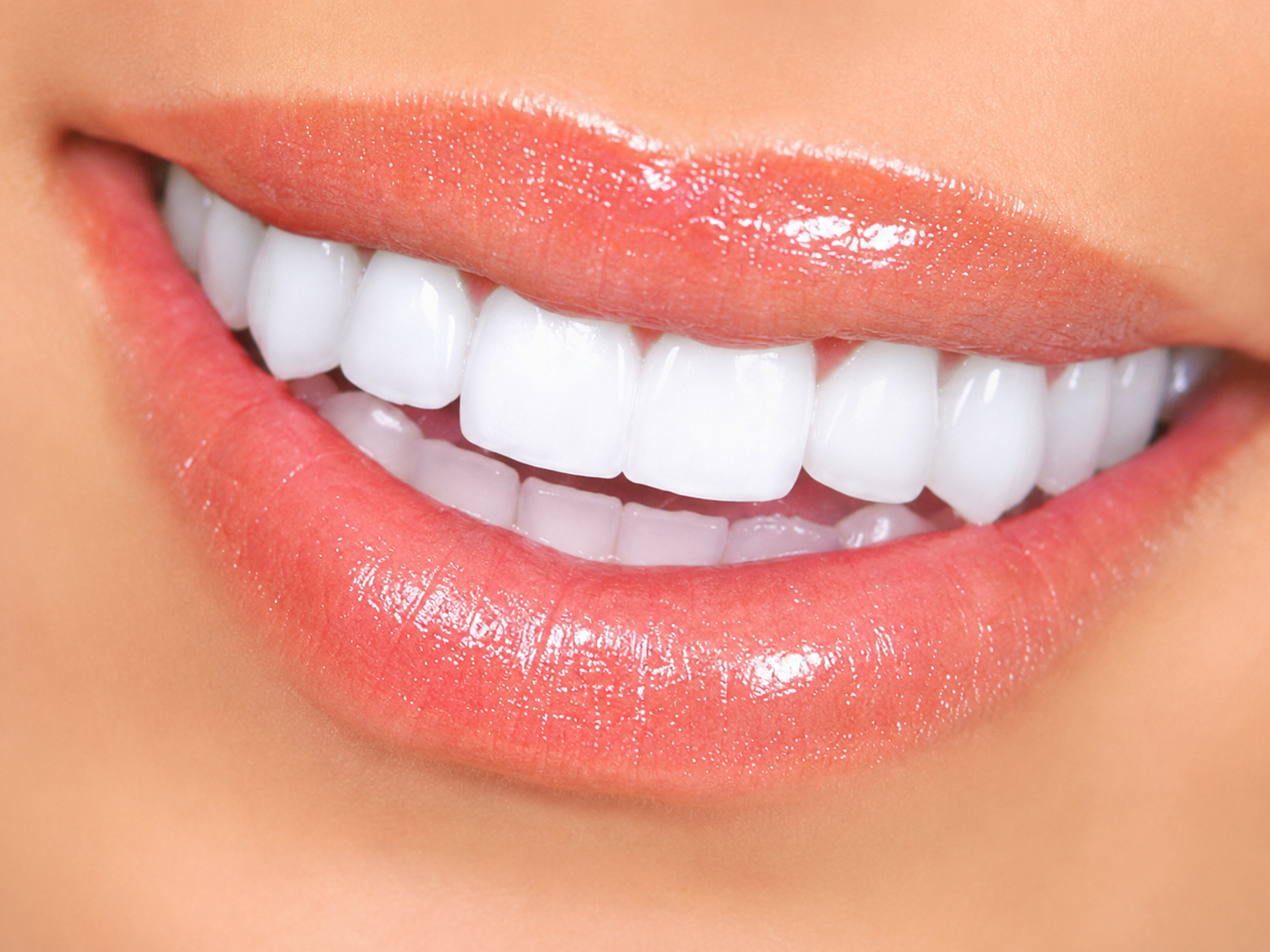 Clareamento Dental — depois