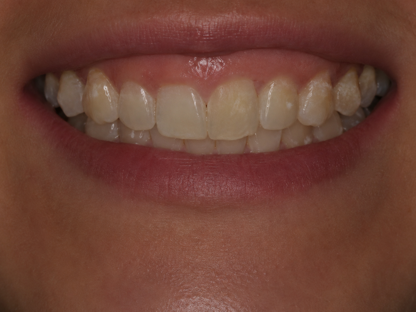 Gengivoplastia — antes