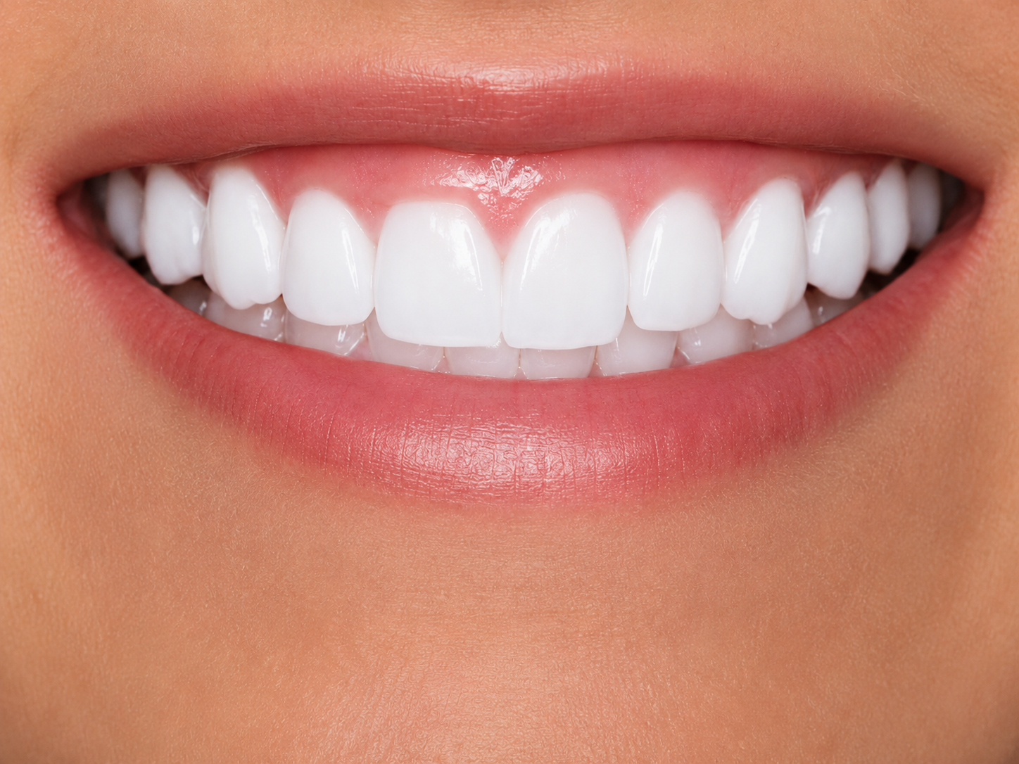 Gengivoplastia — depois