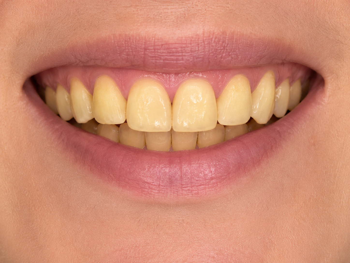 Lentes de Contato Dental — antes