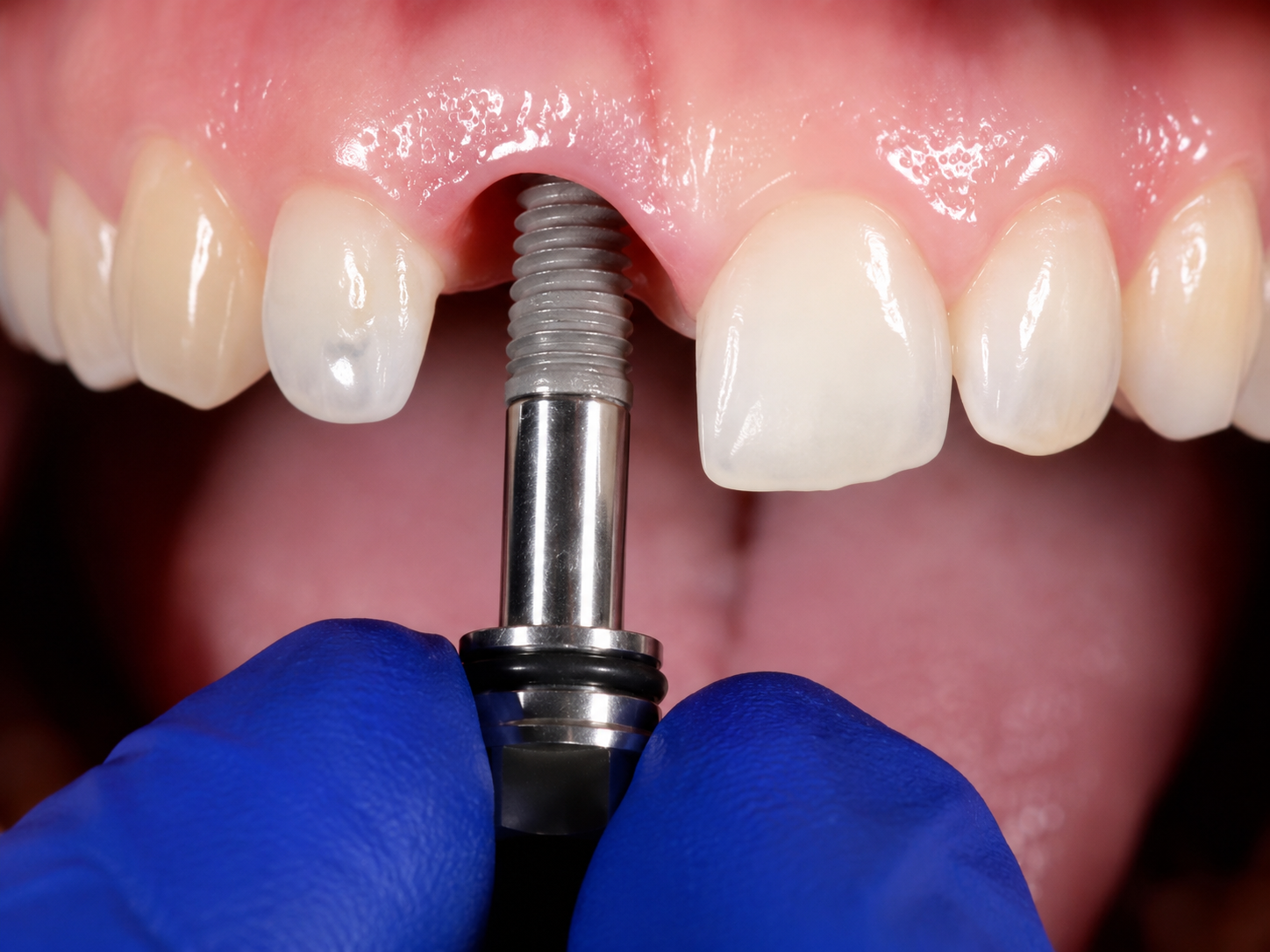 Implantes 1