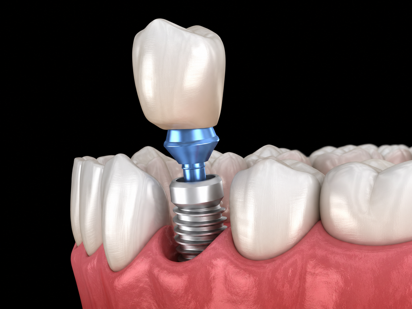 Implantes 2