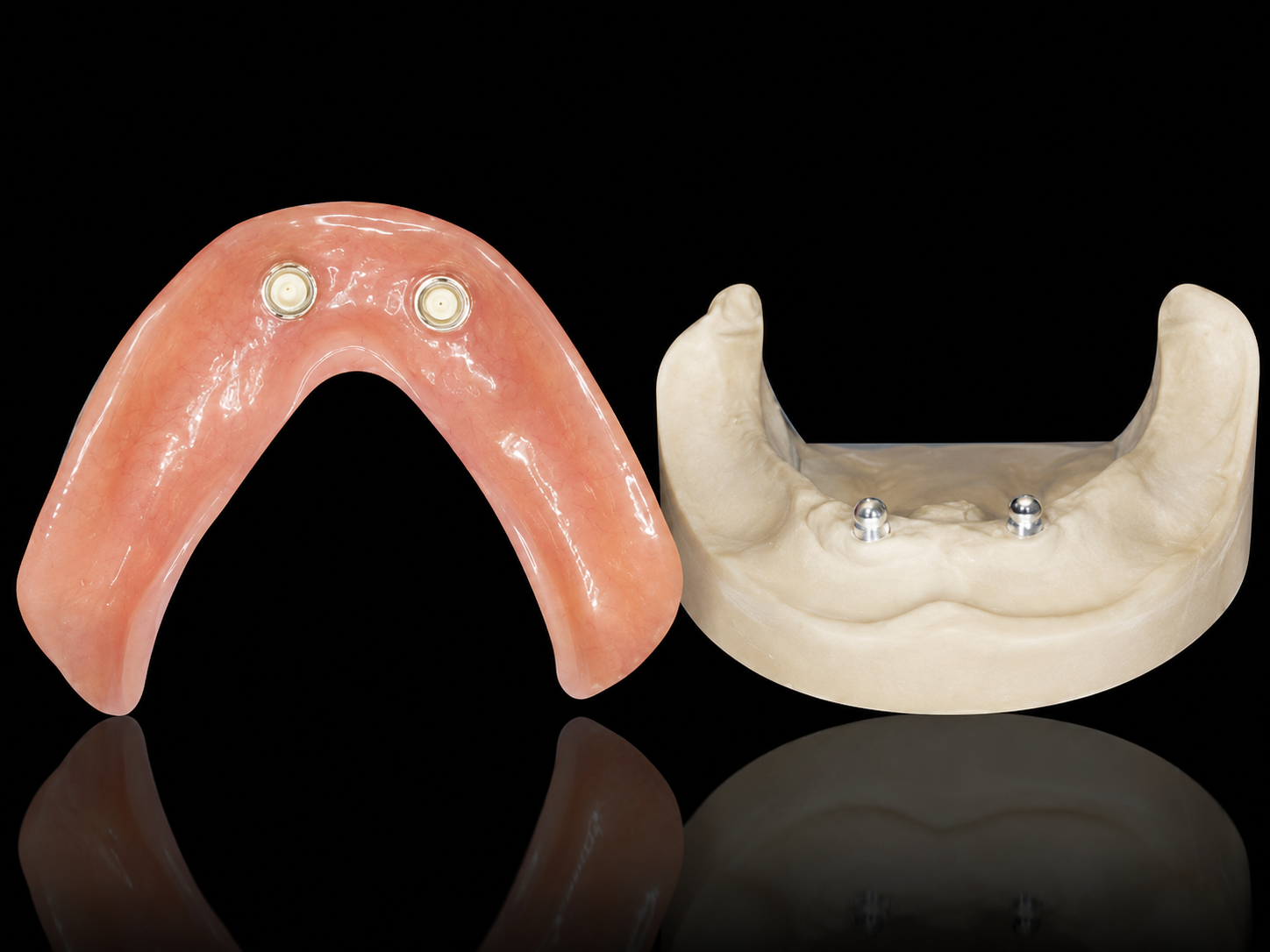 Overdenture (removível)